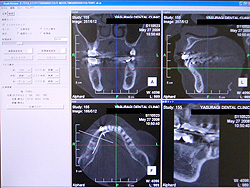 やすらぎ歯科医院では、術前にCT診断(3DCT)を行い、骨の状態の確認、インプラント手術のシミュレーションを行ないます。